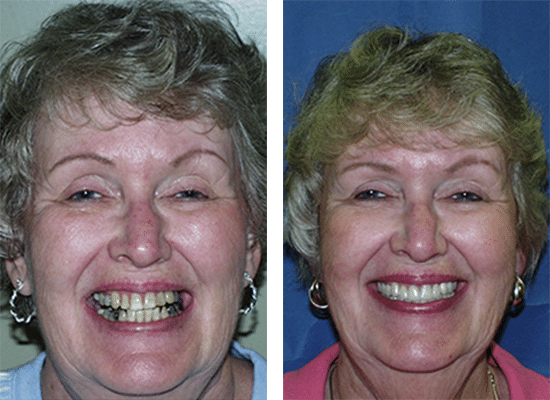Get your fillings replaced with white fillings from Contemporary Dentistry in Rochester, New York