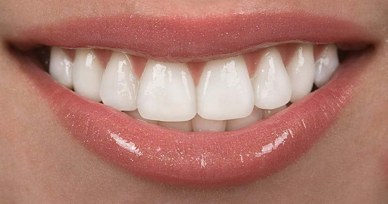 Dental bonding is a great way to make a minor correction