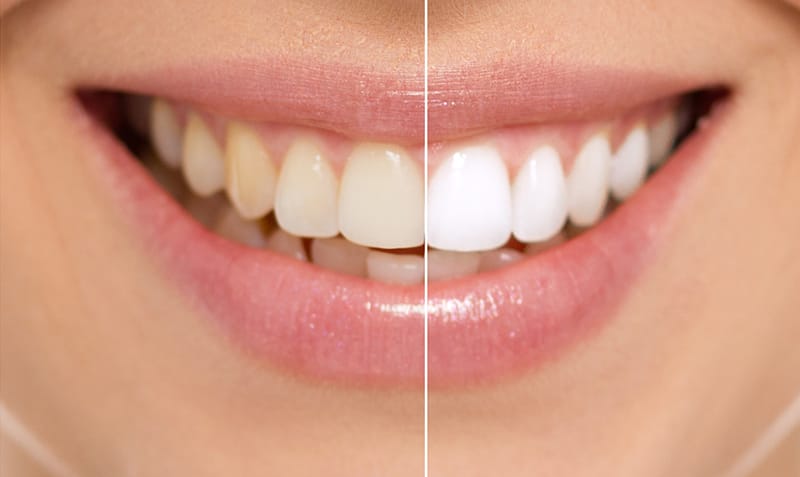 Professional teeth whitening in Rochester, NY