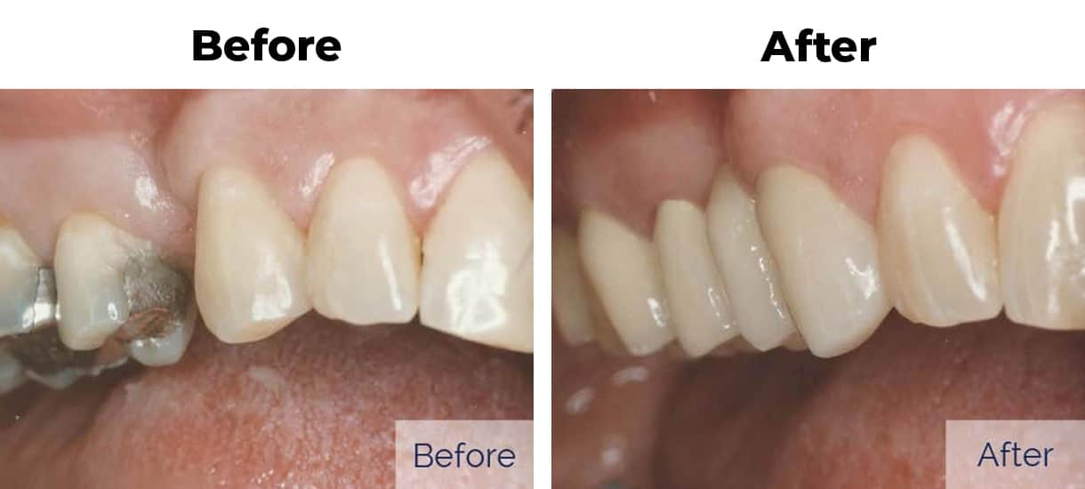 Close up before and after showing gap between front teeth closed with dental bonding