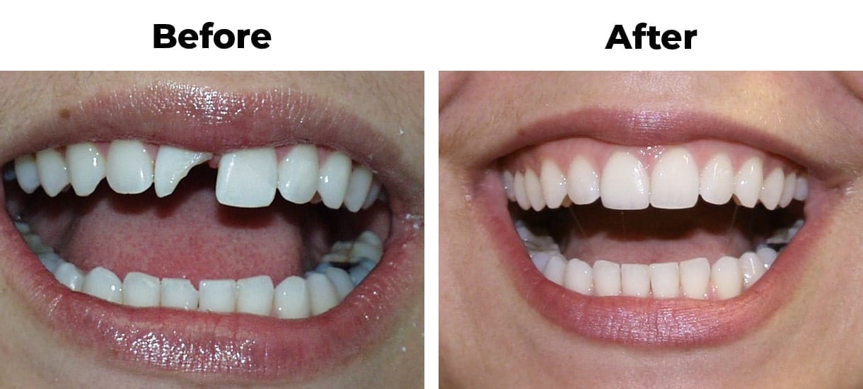 Before and after photos of a patient treated with a porcelain crown to restore a tooth