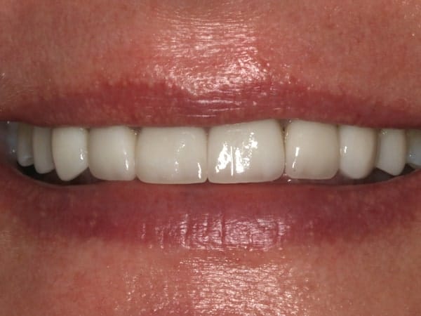 patient's smile after treatment