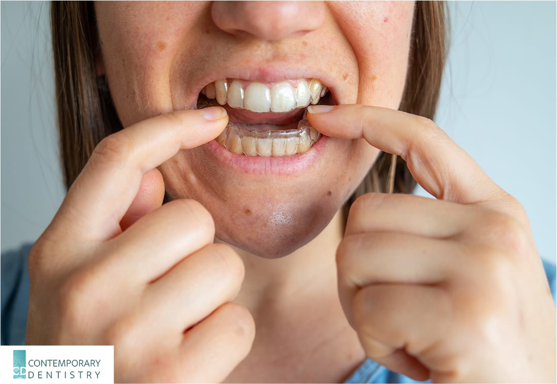 A person inserts clear aligners onto their teeth using both hands.